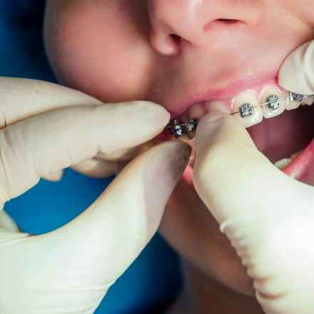Orthodontic Treatment