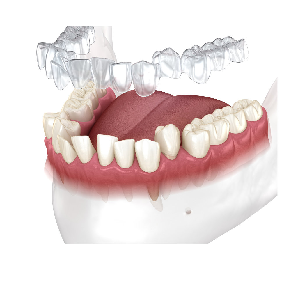 Invisalign Treatment