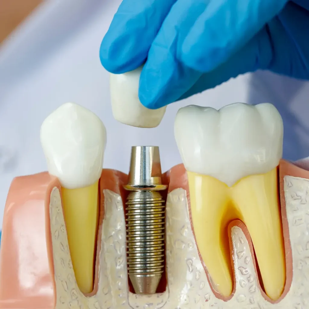 Dental Implants Prosper